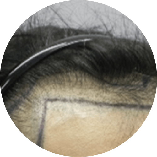 修復髮線